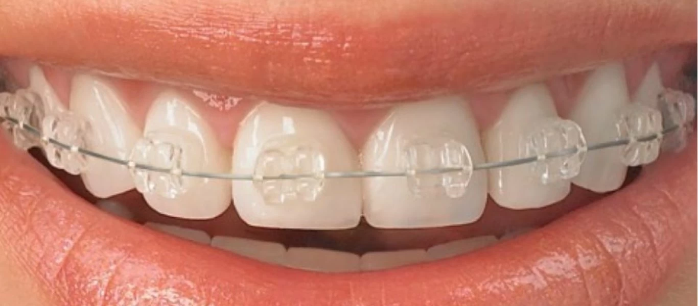 Μύθοι και αλήθειες για τα δόντια και την Ορθοδοντική